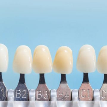 Dental Veneers: Procedure, Problems Solved, Pros, and Cons