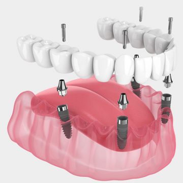 How Do You Clean All-on-4 Dental Implants? A Comprehensive Guide