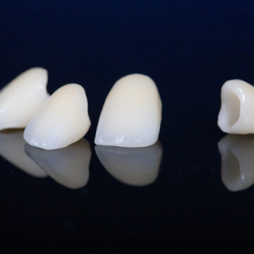 Is It Possible To Whiten Dental Crowns?