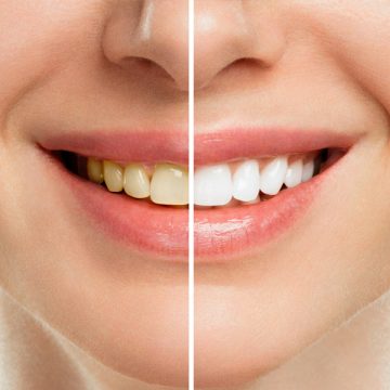 Teeth Whitening for Smokers: What You Should Consider