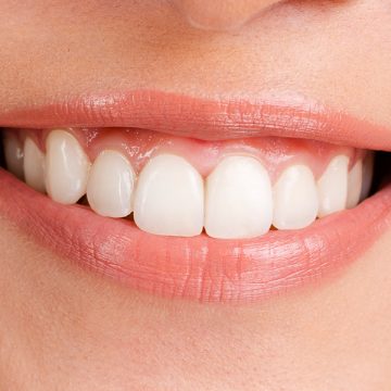 The Benefits of a Complete Smile Makeover for Your Appearance and Health